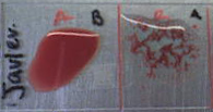 Test sanguin d'un étudiant. Trois gouttes de sang sont mélangées à du sérum anti-B (à gauche) et anti-A (à droite). L'agglutination avec l'anti-A suggère que cet individu est de type A.