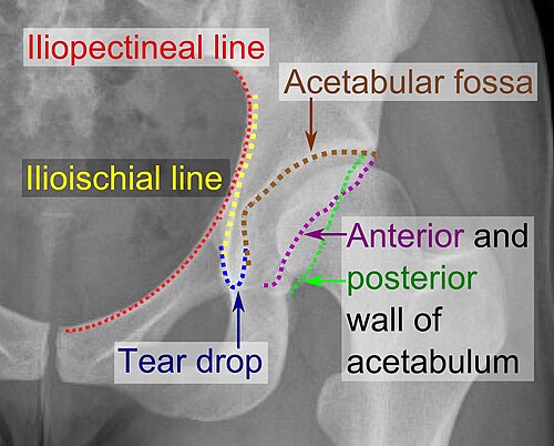 Radiographie de la hanche, avec les mesures utilisées dans la radiographie de la dysplasie de la hanche chez l'adulte.