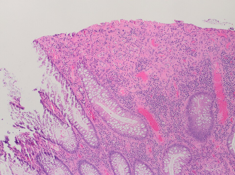 Ulcération (observée ici comme une absence d'épithélium et de tissu de granulation avec de nombreux fibroblastes)
