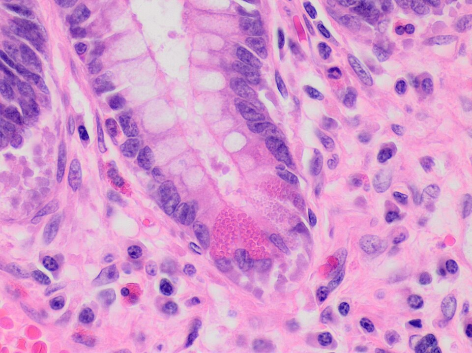 Cellule de Paneth (photo) ou métaplasie gastrique (s'applique uniquement au côlon gauche et au rectum)
