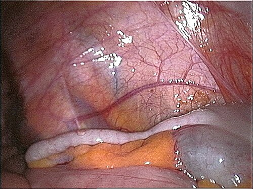 Appendice vermiforme