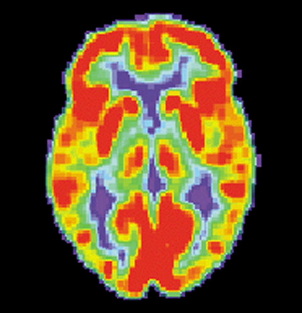 PET Cerveau normal