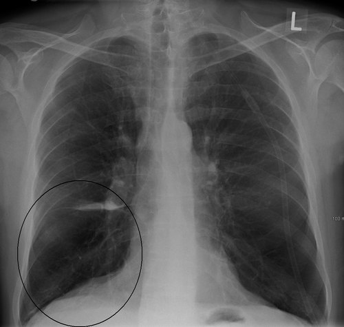 Bulle pulmonaire vue sur une radiographie pulmonaire chez une personne atteinte de BPCO sévère