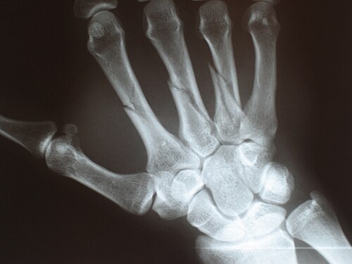 Fractures multiples des métacarpes (ou main cassée). (Main droite représentée avec le pouce à gauche.)