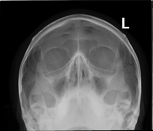 Radiographie des sinus paranasaux (occipito-mentonnier)
