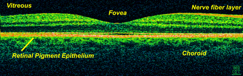 OCT dans le domaine temporel de la zone maculaire d'une rétine à 800 nm, résolution axiale 3 μm