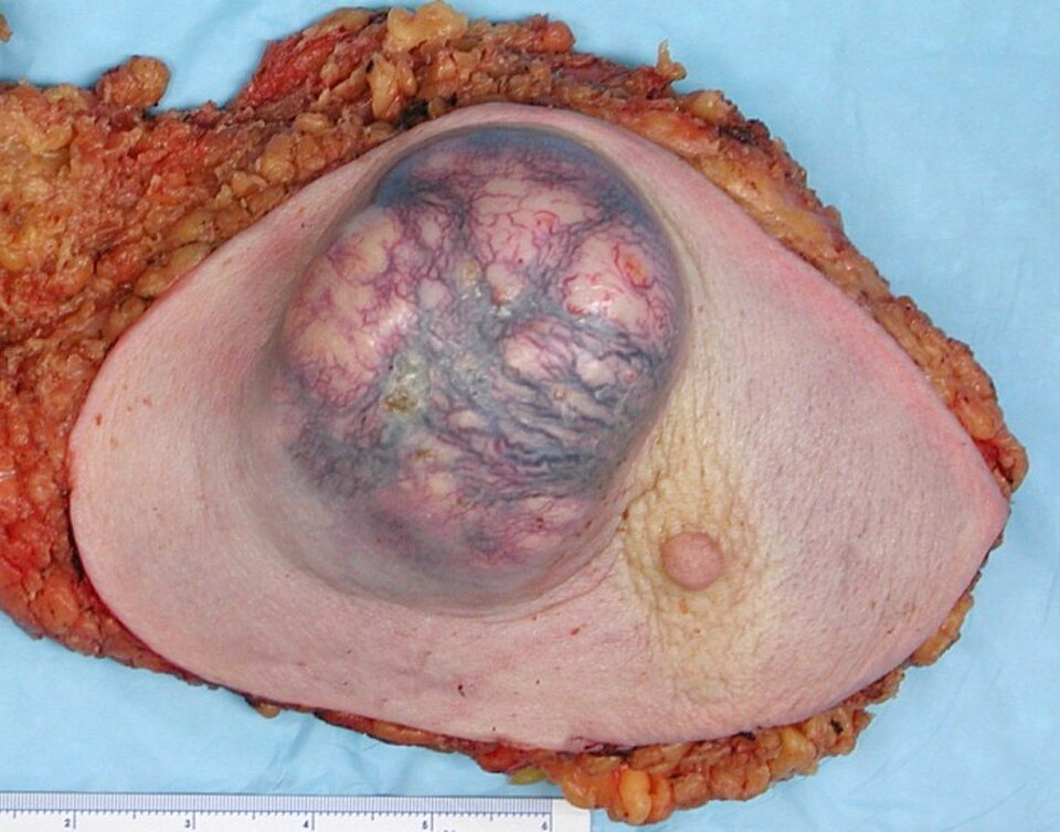 Pièce de mastectomie contenant un très gros cancer du sein (dans ce cas, un carcinome canalaire invasif)