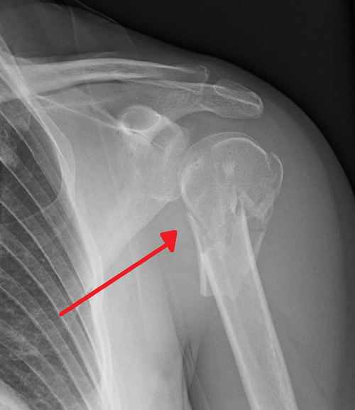 Fracture de l'humérus proximal