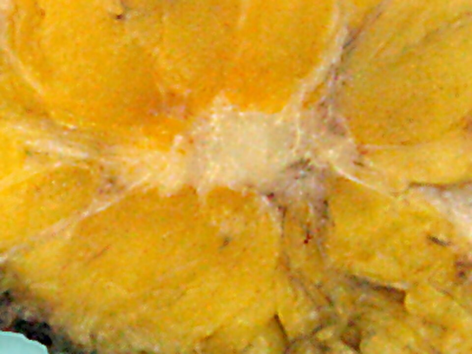 Aspect macroscopique (examen macroscopique) typique de la surface coupée d'un échantillon de mastectomie contenant un cancer, dans ce cas, un carcinome canalaire invasif du sein, zone pâle au centre