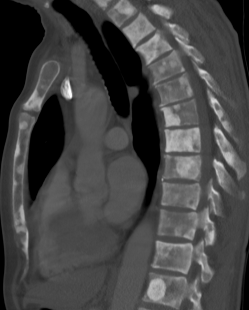 Sclérose des os de la colonne thoracique due à des métastases du cancer de la prostate (image CT)