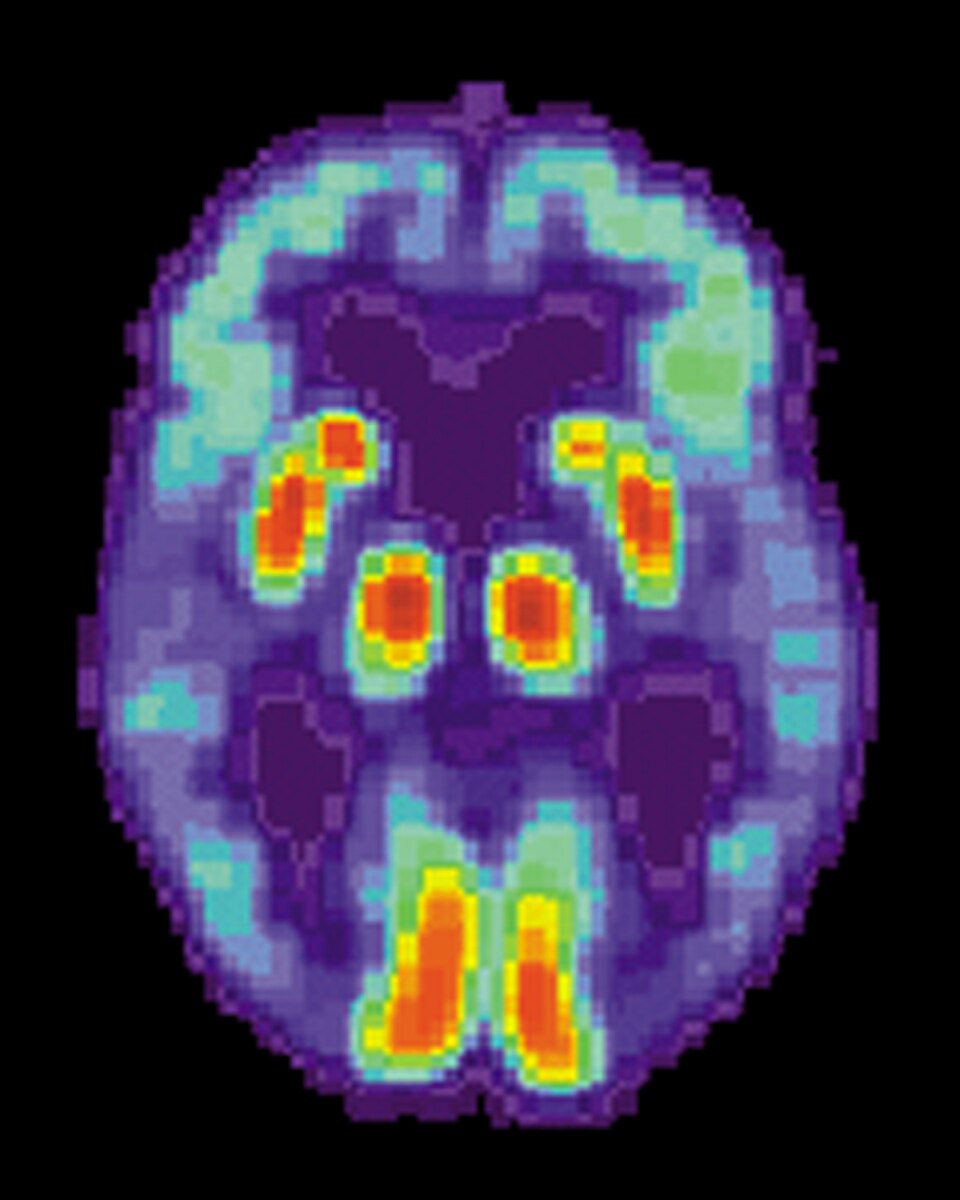 Patient atteint de la maladie d'Alzheimer et soumis à un PET