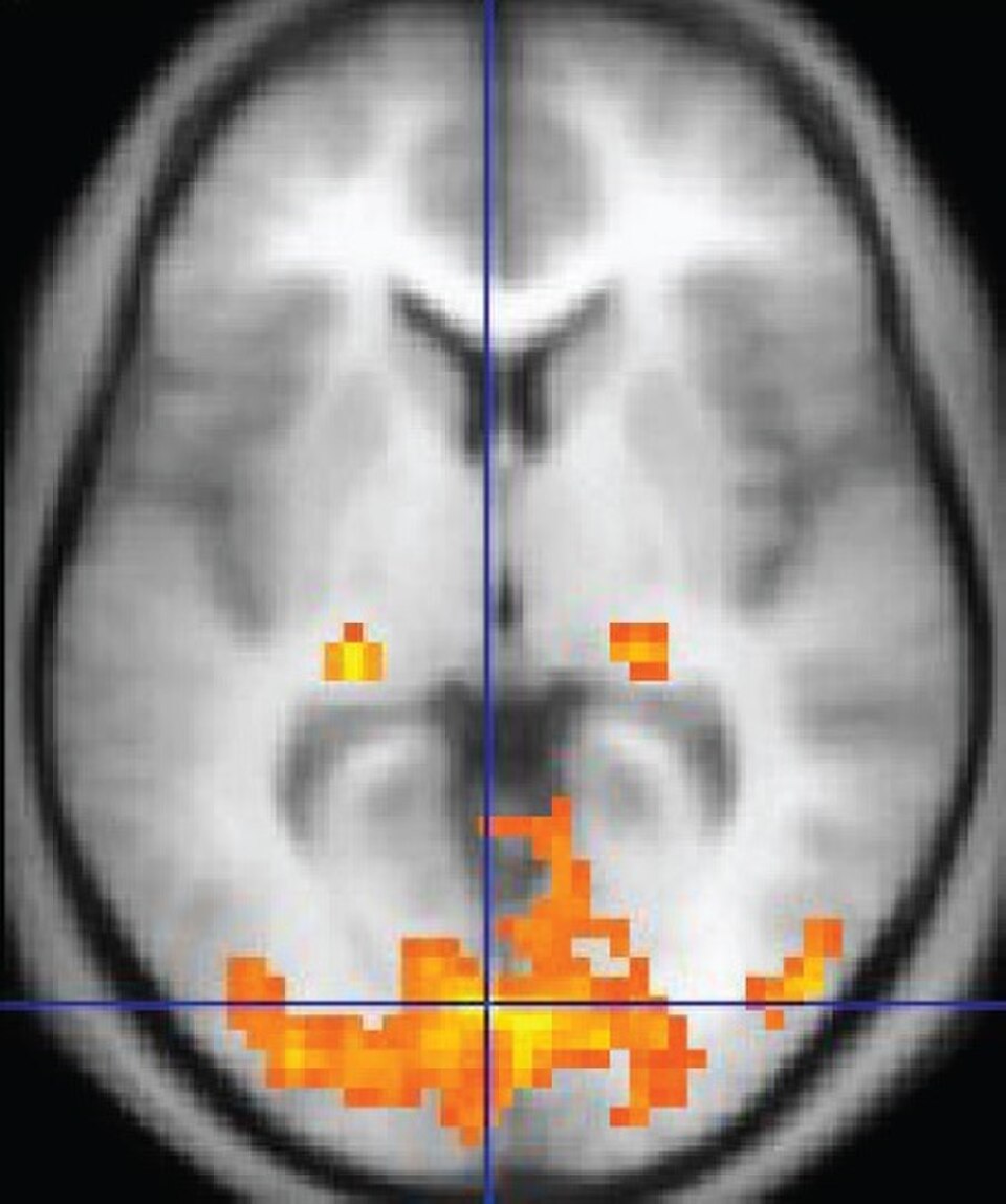 Image IRMf montrant le cerveau vu de dessus, les zones actives étant colorées en orange.