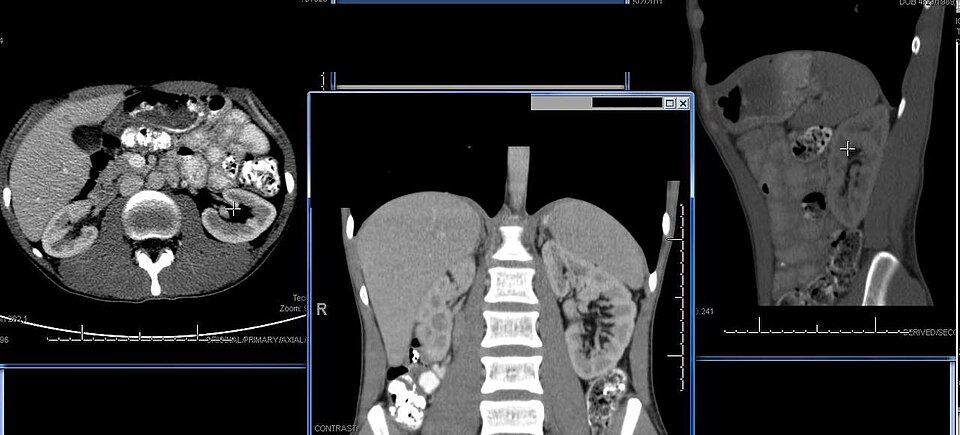 Un scanner de l'abdomen montrant la position des reins. La coupe transversale gauche de la partie supérieure de l'abdomen montre le foie sur le côté gauche du scanner (côté droit du corps). Au centre : coupe transversale montrant les reins sous le foie et la rate. À droite : autre coupe transversale du rein gauche.