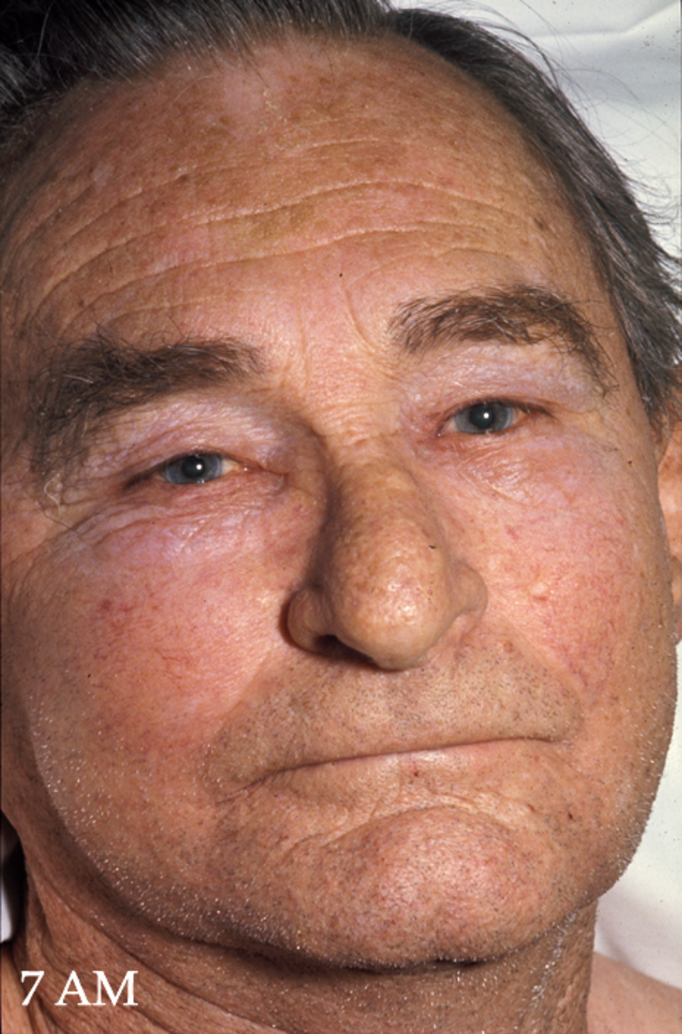 Un homme au visage enflé