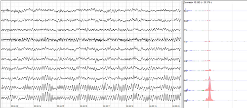 L'échantillon d'EEG humain avec un rythme alpha important dans les sites occipitaux