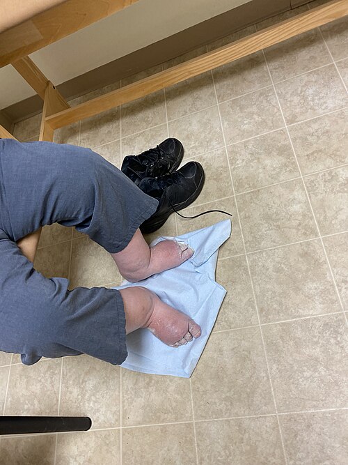 Œdème sévère des jambes et des pieds.