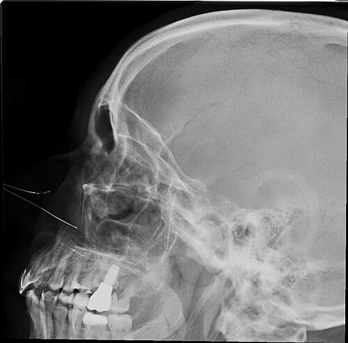 Radiographie des sinus paranasaux (profil)