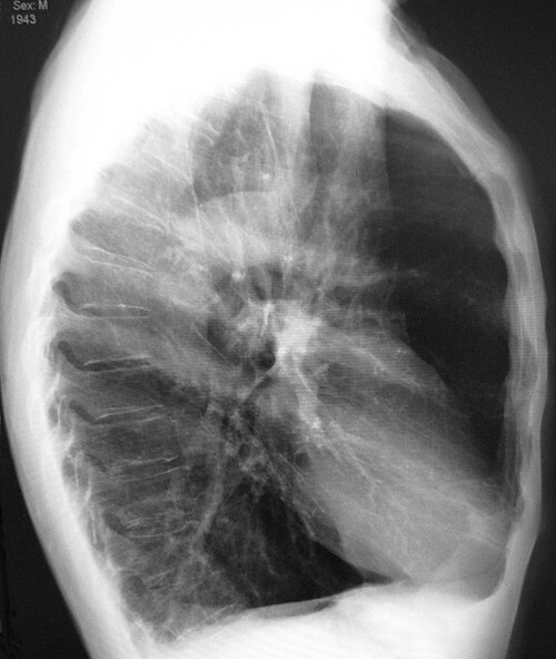 Radiographie thoracique latérale d'une personne atteinte d'emphysème, montrant un thorax en tonneau et un diaphragme plat
