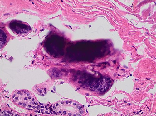L'empilement de cellules les unes sur les autres donne un aspect sombre et, dans ce tissu mammaire, il peut imiter des microcalcifications.