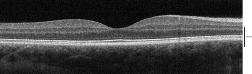 Coupe transversale de la macula par OCT dans le domaine spectral.