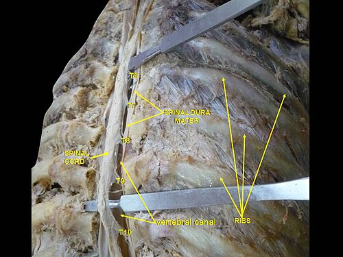 Nerfs spinaux. Moelle épinière et canal vertébral. Dissection profonde.