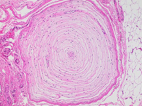 Histologie d'un corpuscule de Pacini, dans un motif circulaire en expansion typique.