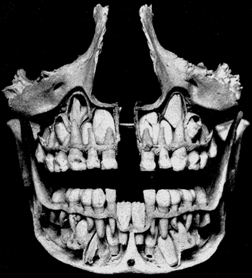 Les dents permanentes non éruptées se trouvent sous les dents temporaires.