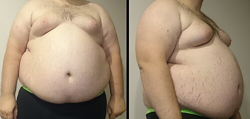 Vue de face et de profil du torse d'un « homme obèse de classe III ». Des vergetures cutanées sont visibles ainsi qu'une gynécomastie.