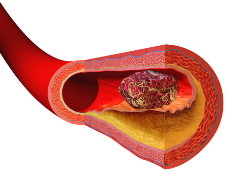 Illustration illustrant la formation d'un thrombus sur une plaque artérielle.