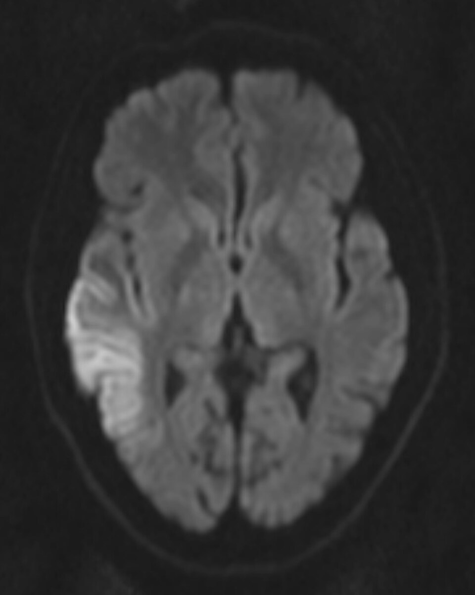 L'IRM de diffusion montre un hypersignal cortical en forme de ruban, compatible avec une restriction de diffusion chez un patient atteint du syndrome MELAS connu.