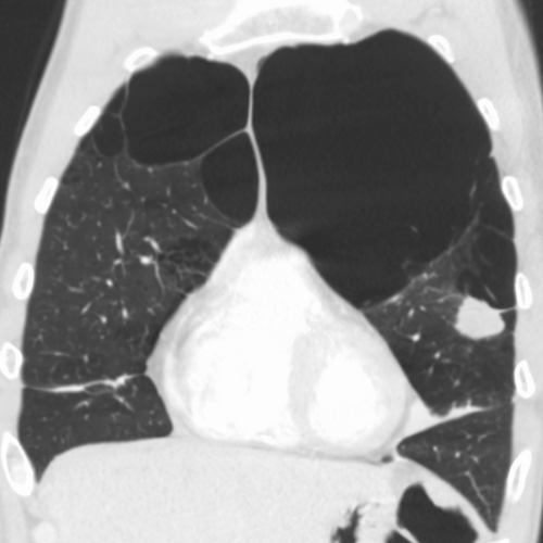 Emphysème très sévère avec cancer du poumon gauche (scanner)