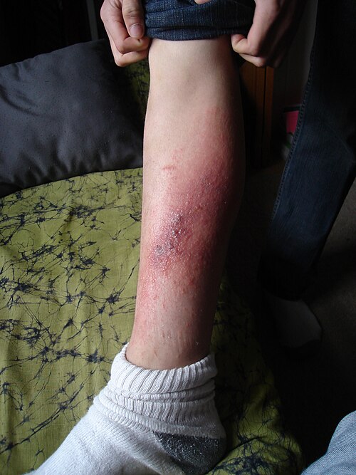 éruption cutanée sur la jambe