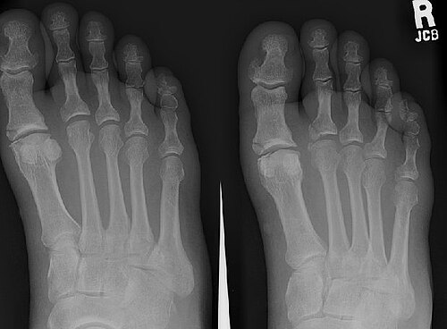 Radiographie du pied.