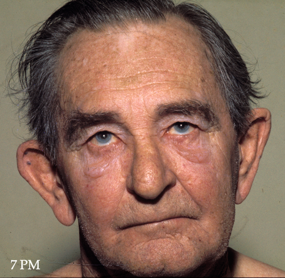 Le même homme, sans gonflement au visage.