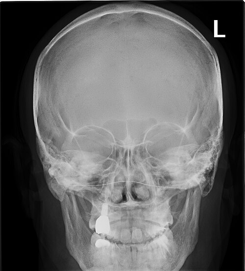 Radiographie des sinus paranasaux (occipito-frontale)