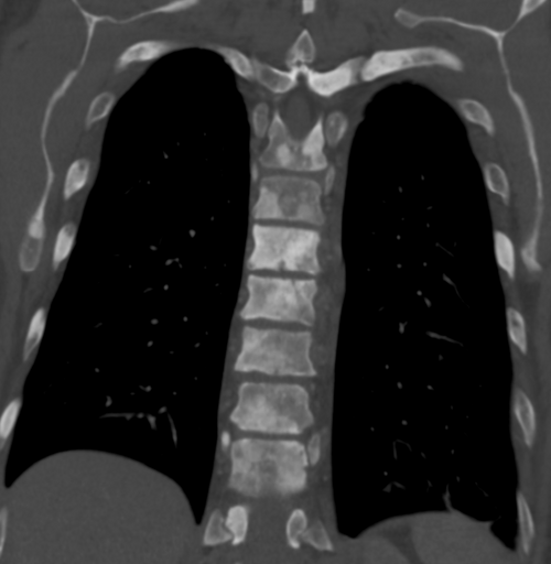Sclérose des os de la colonne thoracique due à des métastases du cancer de la prostate (image CT)