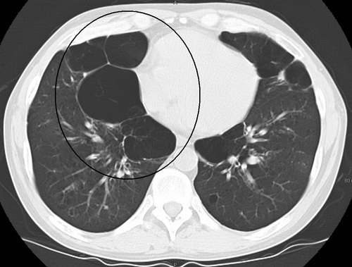 Image CT axiale du poumon d'une personne atteinte d'emphysème bulleux en phase terminale